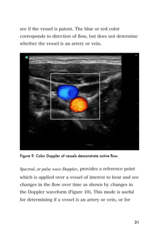 see if the vessel is patent. The blue or red color
corresponds to direction of ﬂow, but does not determine
whether the vessel is an artery or vein.




Figure 9. Color Doppler of vessels demonstrate active ﬂow.


Spectral, or pulse wave Doppler, provides a reference point
which is applied over a vessel of interest to hear and see
changes in the ﬂow over time as shown by changes in
the Doppler waveform (Figure 10). This mode is useful
for determining if a vessel is an artery or vein, or for




                                                             31
 