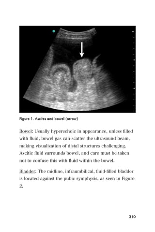Figure 1. Ascites and bowel (arrow)


Bowel: Usually hyperechoic in appearance, unless ﬁlled
with ﬂuid, bowel gas can scatter the ultrasound beam,
making visualization of distal structures challenging.
Ascitic ﬂuid surrounds bowel, and care must be taken
not to confuse this with ﬂuid within the bowel.

Bladder: The midline, infraumbilical, ﬂuid-ﬁlled bladder
is located against the pubic symphysis, as seen in Figure
2.




                                                         310
 
