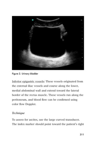 Figure 2. Urinary bladder


Inferior epigastric vessels: These vessels originated from
the external iliac vessels and course along the lower,
medial abdominal wall and extend toward the lateral
border of the rectus muscle. These vessels run along the
peritoneum, and blood ﬂow can be conﬁrmed using
color ﬂow Doppler.


Technique

To assess for ascites, use the large curved transducer.
The index marker should point toward the patient s right


                                                          311
 