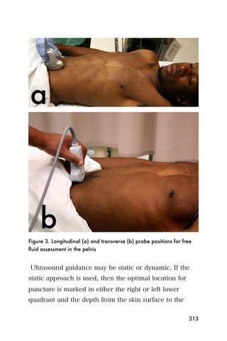 Figure 3. Longitudinal (a) and transverse (b) probe positions for free
ﬂuid assessment in the pelvis


Ultrasound guidance may be static or dynamic. If the
static approach is used, then the optimal location for
puncture is marked in either the right or left lower
quadrant and the depth from the skin surface to the

                                                                    313
 