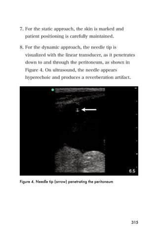 7. For the static approach, the skin is marked and
   patient positioning is carefully maintained.

8. For the dynamic approach, the needle tip is
   visualized with the linear transducer, as it penetrates
   down to and through the peritoneum, as shown in
   Figure 4. On ultrasound, the needle appears
   hyperechoic and produces a reverberation artifact.




Figure 4. Needle tip (arrow) penetrating the peritoneum




                                                          315
 