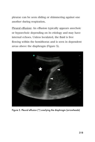 pleurae can be seen sliding or shimmering against one
another during respiration.

Pleural eﬀusion: An eﬀusion typically appears anechoic
or hypoechoic depending on its etiology and may have
internal echoes. Unless loculated, the ﬂuid is free
ﬂowing within the hemithorax and is seen in dependent
areas above the diaphragm (Figure 5).




Figure 5. Pleural effusion (*) overlying the diaphragm (arrowheads)




                                                                  318
 