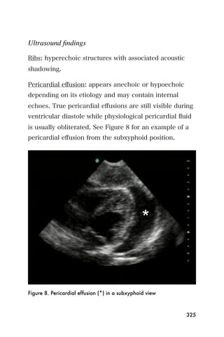 Ultrasound ﬁndings

Ribs: hyperechoic structures with associated acoustic
shadowing.

Pericardial eﬀusion: appears anechoic or hypoechoic
depending on its etiology and may contain internal
echoes. True pericardial eﬀusions are still visible during
ventricular diastole while physiological pericardial ﬂuid
is usually obliterated. See Figure 8 for an example of a
pericardial eﬀusion from the subxyphoid position.




Figure 8. Pericardial effusion (*) in a subxyphoid view



                                                          325
 