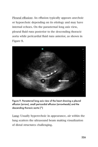 Pleural eﬀusion: An eﬀusion typically appears anechoic
or hypoechoic depending on its etiology and may have
internal echoes. On the parasternal long axis view,
pleural ﬂuid runs posterior to the descending thoracic
aorta while pericardial ﬂuid runs anterior, as shown in
Figure 9.




Figure 9. Parasternal long axis view of the heart showing a pleural
effusion (arrow), small pericardial effusion (arrowheads) and the
descending thoracic aorta (*)


Lung: Usually hyperechoic in appearance, air within the
lung scatters the ultrasound beam making visualization
of distal structures challenging.



                                                                      326
 