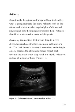 Artifacts

Occasionally the ultrasound image will not truly reﬂect
what is going on inside the body. Artifacts seen on the
ultrasound screen are due to principles of ultrasound
physics and how the machine processes them. Artifacts
should be understood to avoid misdiagnosis.

Shadowing is an artifact that occurs deep to a very
dense, hyperechoic structure, such as a gallstone or a
rib. The dark line of a shadow is seen deep to the bright
object, because the ultrasound waves reﬂect back
towards the probe when they reach the highly reﬂective
surface of a stone or bone (Figure 11).




Figure 11. Gallstones (arrows) create shadow artifact (*).


                                                             33
 