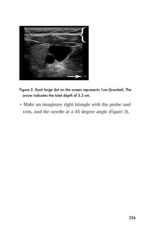 Figure 2. Each large dot on the screen represents 1cm (bracket). The
 arrow indicates the total depth of 3.3 cm.

• Make an imaginary right triangle with the probe and
 vein, and the needle at a 45 degree angle (Figure 3).




                                                                  336
 