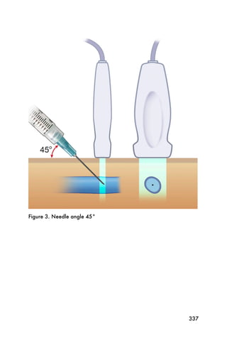 Figure 3. Needle angle 45°




                             337
 