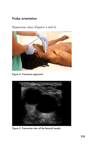 Probe orientation

Transverse views (Figures 4 and 5)




Figure 4. Transverse approach




Figure 5. Transverse view of the femoral vessels


                                                   338
 