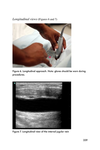Longitudinal views (Figures 6 and 7)




Figure 6. Longitudinal approach. Note: gloves should be worn during
procedures.




Figure 7. Longitudinal view of the internal jugular vein


                                                                339
 