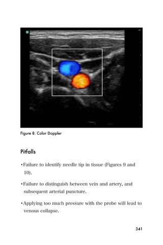 Figure 8. Color Doppler




Pitfalls

•Failure to identify needle tip in tissue (Figures 9 and
 10).

•Failure to distinguish between vein and artery, and
 subsequent arterial puncture.

•Applying too much pressure with the probe will lead to
 venous collapse.


                                                           341
 