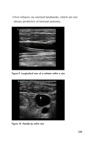 •Over reliance on external landmarks, which are not
  always predictive of internal anatomy.




Figure 9. Longitudinal view of a catheter within a vein




Figure 10. Needle tip within vein


                                                          342
 