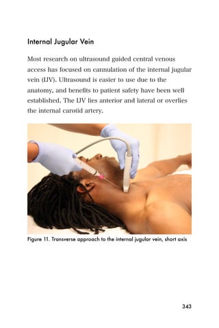 Internal Jugular Vein

Most research on ultrasound guided central venous
access has focused on cannulation of the internal jugular
vein (IJV). Ultrasound is easier to use due to the
anatomy, and beneﬁts to patient safety have been well
established. The IJV lies anterior and lateral or overlies
the internal carotid artery.




Figure 11. Transverse approach to the internal jugular vein, short axis




                                                                    343
 