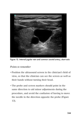 Figure 12. Internal jugular vein and common carotid artery, short axis



Points to remember

• Position the ultrasound screen in the clinician s ﬁeld of
 view, so that the clinician can see the screen as well as
 their hands without turning their head.

• The probe and screen markers should point in the
 same direction to aid minor adjustments during the
 procedure, and avoid the confusion of having to move
 the needle in the direction opposite the probe (Figure
 13).




                                                                   344
 