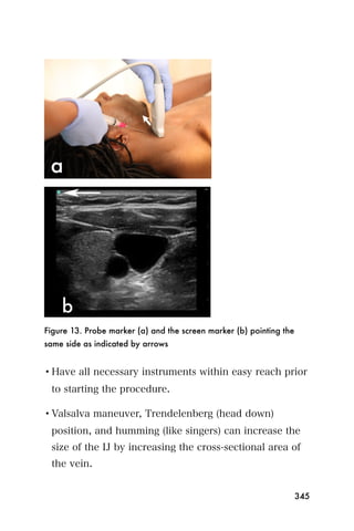 Figure 13. Probe marker (a) and the screen marker (b) pointing the
same side as indicated by arrows


• Have all necessary instruments within easy reach prior
 to starting the procedure.

• Valsalva maneuver, Trendelenberg (head down)
 position, and humming (like singers) can increase the
 size of the IJ by increasing the cross-sectional area of
 the vein.


                                                                     345
 