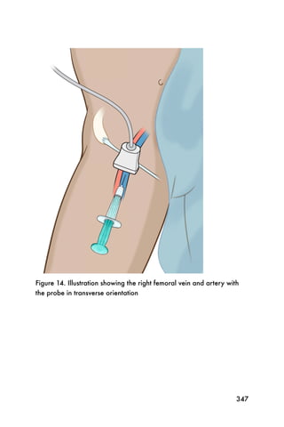 Figure 14. Illustration showing the right femoral vein and artery with
the probe in transverse orientation




                                                                     347
 