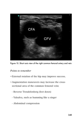 Figure 15. Short axis view of the right common femoral artery and vein



Points to remember

• External rotation of the hip may improve success.

• Augmentation maneuvers may increase the cross-
 sectional area of the common femoral vein:

 - Reverse Trendelenberg (feet down)

 - Valsalva, such as humming like a singer

 - Abdominal compression




                                                                  348
 