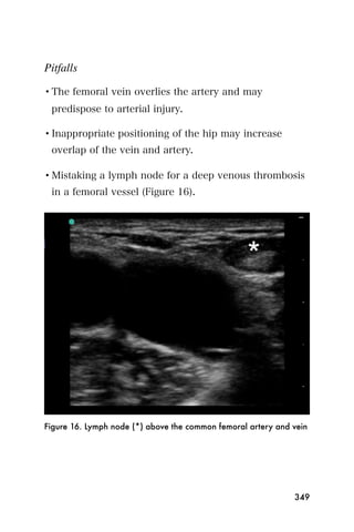 Pitfalls

• The femoral vein overlies the artery and may
 predispose to arterial injury.

• Inappropriate positioning of the hip may increase
 overlap of the vein and artery.

• Mistaking a lymph node for a deep venous thrombosis
 in a femoral vessel (Figure 16).




Figure 16. Lymph node (*) above the common femoral artery and vein




                                                              349
 