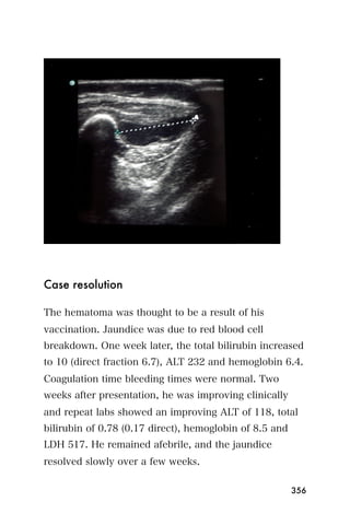 Case resolution

The hematoma was thought to be a result of his
vaccination. Jaundice was due to red blood cell
breakdown. One week later, the total bilirubin increased
to 10 (direct fraction 6.7), ALT 232 and hemoglobin 6.4.
Coagulation time bleeding times were normal. Two
weeks after presentation, he was improving clinically
and repeat labs showed an improving ALT of 118, total
bilirubin of 0.78 (0.17 direct), hemoglobin of 8.5 and
LDH 517. He remained afebrile, and the jaundice
resolved slowly over a few weeks.

                                                         356
 
