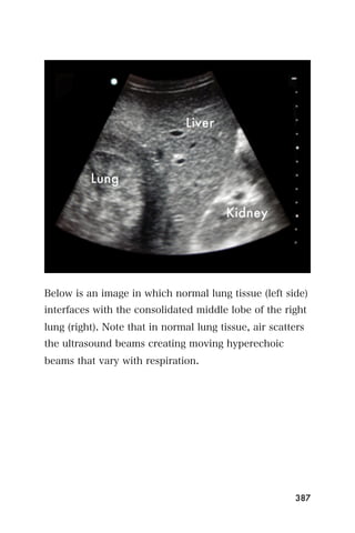 Below is an image in which normal lung tissue (left side)
interfaces with the consolidated middle lobe of the right
lung (right). Note that in normal lung tissue, air scatters
the ultrasound beams creating moving hyperechoic
beams that vary with respiration.




                                                         387
 