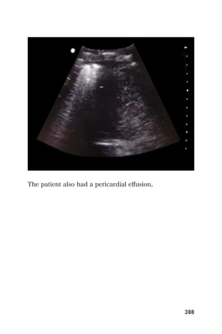 The patient also had a pericardial eﬀusion.




                                              388
 