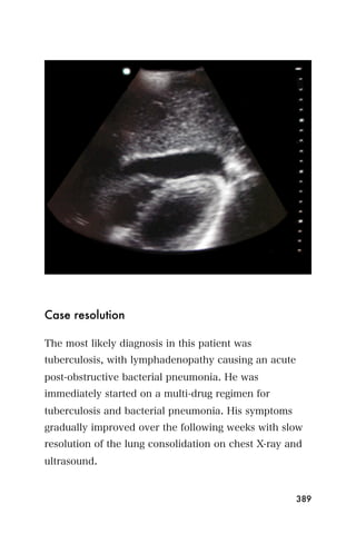 Case resolution

The most likely diagnosis in this patient was
tuberculosis, with lymphadenopathy causing an acute
post-obstructive bacterial pneumonia. He was
immediately started on a multi-drug regimen for
tuberculosis and bacterial pneumonia. His symptoms
gradually improved over the following weeks with slow
resolution of the lung consolidation on chest X-ray and
ultrasound.


                                                      389
 