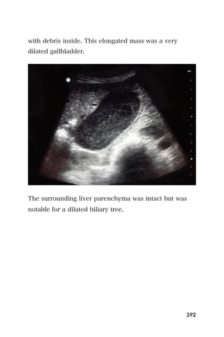 with debris inside. This elongated mass was a very
dilated gallbladder.




The surrounding liver parenchyma was intact but was
notable for a dilated biliary tree.




                                                     392
 