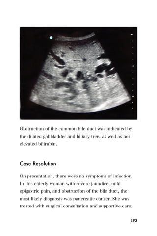 Obstruction of the common bile duct was indicated by
the dilated gallbladder and biliary tree, as well as her
elevated bilirubin.



Case Resolution

On presentation, there were no symptoms of infection.
In this elderly woman with severe jaundice, mild
epigastric pain, and obstruction of the bile duct, the
most likely diagnosis was pancreatic cancer. She was
treated with surgical consultation and supportive care.


                                                           393
 