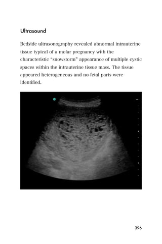 Ultrasound

Bedside ultrasonography revealed abnormal intrauterine
tissue typical of a molar pregnancy with the
characteristic snowstorm appearance of multiple cystic
spaces within the intrauterine tissue mass. The tissue
appeared heterogeneous and no fetal parts were
identiﬁed.




                                                         396
 