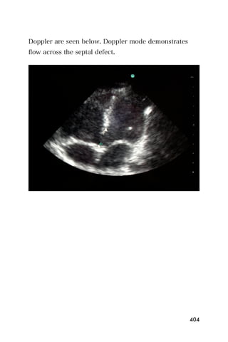 Doppler are seen below. Doppler mode demonstrates
ﬂow across the septal defect.




                                                    404
 