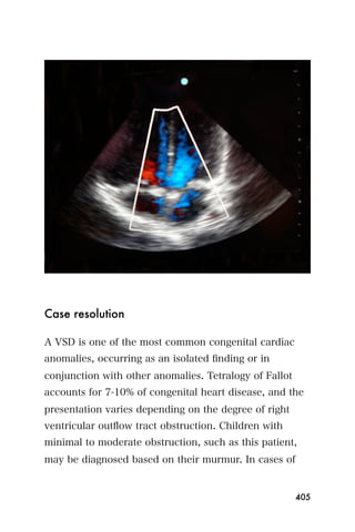 Case resolution

A VSD is one of the most common congenital cardiac
anomalies, occurring as an isolated ﬁnding or in
conjunction with other anomalies. Tetralogy of Fallot
accounts for 7-10% of congenital heart disease, and the
presentation varies depending on the degree of right
ventricular outﬂow tract obstruction. Children with
minimal to moderate obstruction, such as this patient,
may be diagnosed based on their murmur. In cases of


                                                        405
 
