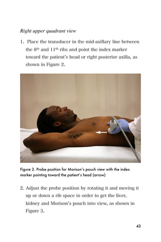 Right upper quadrant view

1. Place the transducer in the mid-axillary line between
   the 8th and 11th ribs and point the index marker
   toward the patient s head or right posterior axilla, as
   shown in Figure 2.




Figure 2. Probe position for Morison’s pouch view with the index
marker pointing toward the patient’s head (arrow)


2. Adjust the probe position by rotating it and moving it
   up or down a rib space in order to get the liver,
   kidney and Morison s pouch into view, as shown in
   Figure 3.


                                                                   43
 