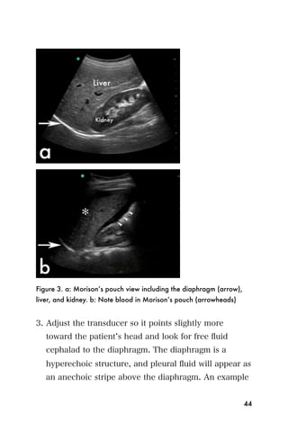 Figure 3. a: Morison’s pouch view including the diaphragm (arrow),
liver, and kidney. b: Note blood in Morison’s pouch (arrowheads)


3. Adjust the transducer so it points slightly more
   toward the patient s head and look for free ﬂuid
   cephalad to the diaphragm. The diaphragm is a
   hyperechoic structure, and pleural ﬂuid will appear as
   an anechoic stripe above the diaphragm. An example


                                                                     44
 