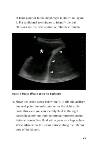 of ﬂuid superior to the diaphragm is shown in Figure
   4. For additional techniques to identify pleural
   eﬀusions see the next section on Thoracic trauma.




Figure 4. Pleural effusion above the diaphragm


4. Move the probe down below the 11th rib mid-axillary
   line and point the index marker to the right axilla.
   From this view you can identify ﬂuid in the right
   paracolic gutter and right pararenal retroperitoneum.
   Retroperitoneal free ﬂuid will appear as a hypoechoic
   stripe adjacent to the psoas muscle along the inferior
   pole of the kidney.


                                                          45
 