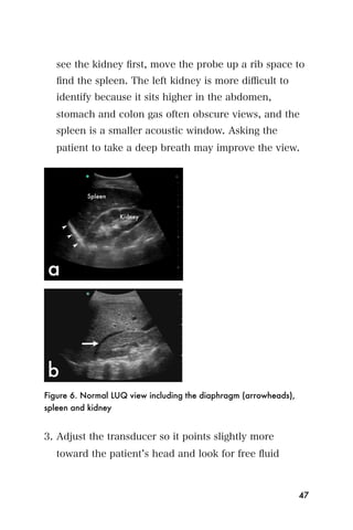 see the kidney ﬁrst, move the probe up a rib space to
   ﬁnd the spleen. The left kidney is more diﬃcult to
   identify because it sits higher in the abdomen,
   stomach and colon gas often obscure views, and the
   spleen is a smaller acoustic window. Asking the
   patient to take a deep breath may improve the view.




Figure 6. Normal LUQ view including the diaphragm (arrowheads),
spleen and kidney


3. Adjust the transducer so it points slightly more
   toward the patient s head and look for free ﬂuid



                                                                  47
 