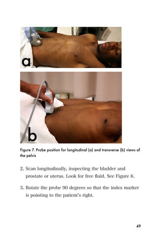 Figure 7. Probe position for longitudinal (a) and transverse (b) views of
the pelvis


2. Scan longitudinally, inspecting the bladder and
   prostate or uterus. Look for free ﬂuid. See Figure 8.

3. Rotate the probe 90 degrees so that the index marker
   is pointing to the patient s right.




                                                                      49
 