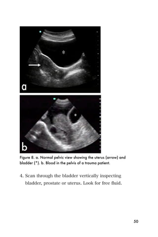 Figure 8. a. Normal pelvic view showing the uterus (arrow) and
bladder (*). b. Blood in the pelvis of a trauma patient.


4. Scan through the bladder vertically inspecting
   bladder, prostate or uterus. Look for free ﬂuid.




                                                                 50
 