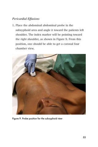 Pericardial Effusions

1. Place the abdominal abdominal probe in the
   subxyphoid area and angle it toward the patients left
   shoulder. The index marker will be pointing toward
   the right shoulder, as shown in Figure 9. From this
   position, one should be able to get a coronal four
   chamber view.




Figure 9. Probe position for the subxyphoid view




                                                         53
 