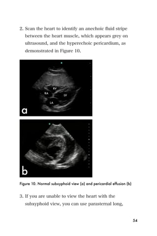 2. Scan the heart to identify an anechoic ﬂuid stripe
   between the heart muscle, which appears grey on
   ultrasound, and the hyperechoic pericardium, as
   demonstrated in Figure 10.




Figure 10. Normal subxyphoid view (a) and pericardial effusion (b)


3. If you are unable to view the heart with the
   subxyphoid view, you can use parasternal long,


                                                                     54
 