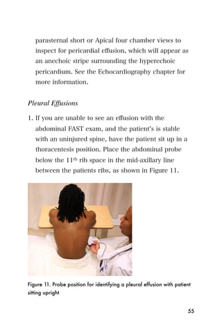 parasternal short or Apical four chamber views to
   inspect for pericardial eﬀusion, which will appear as
   an anechoic stripe surrounding the hyperechoic
   pericardium. See the Echocardiography chapter for
   more information.


Pleural Effusions

1. If you are unable to see an eﬀusion with the
   abdominal FAST exam, and the patient s is stable
   with an uninjured spine, have the patient sit up in a
   thoracentesis position. Place the abdominal probe
   below the 11th rib space in the mid-axillary line
   between the patients ribs, as shown in Figure 11.




Figure 11. Probe position for identifying a pleural effusion with patient
sitting upright


                                                                       55
 