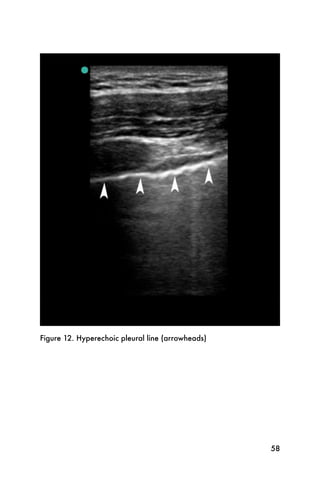 Figure 12. Hyperechoic pleural line (arrowheads)




                                                   58
 