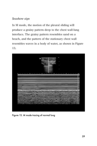 Seashore sign

In M mode, the motion of the pleural sliding will
produce a grainy pattern deep to the chest wall-lung
interface. The grainy pattern resembles sand on a
beach, and the pattern of the stationary chest wall
resembles waves in a body of water, as shown in Figure
13.




Figure 13. M mode tracing of normal lung




                                                       59
 