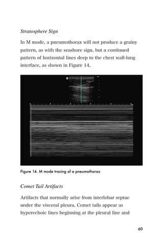 Stratosphere Sign

In M mode, a pneumothorax will not produce a grainy
pattern, as with the seashore sign, but a continued
pattern of horizontal lines deep to the chest wall-lung
interface, as shown in Figure 14.




Figure 14. M mode tracing of a pneumothorax



Comet Tail Artifacts

Artifacts that normally arise from interlobar septae
under the visceral pleura. Comet tails appear as
hyperechoic lines beginning at the pleural line and


                                                          60
 