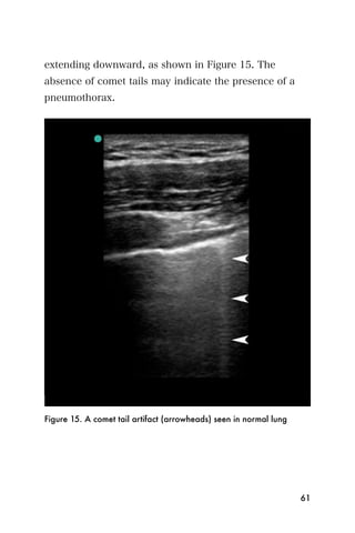 extending downward, as shown in Figure 15. The
absence of comet tails may indicate the presence of a
pneumothorax.




Figure 15. A comet tail artifact (arrowheads) seen in normal lung




                                                                    61
 