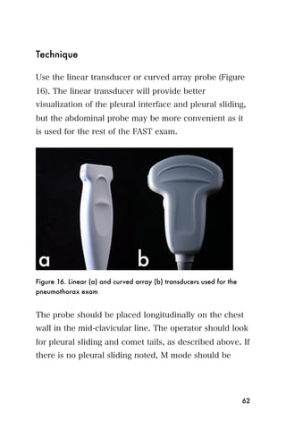 Technique

Use the linear transducer or curved array probe (Figure
16). The linear transducer will provide better
visualization of the pleural interface and pleural sliding,
but the abdominal probe may be more convenient as it
is used for the rest of the FAST exam.




Figure 16. Linear (a) and curved array (b) transducers used for the
pneumothorax exam


The probe should be placed longitudinally on the chest
wall in the mid-clavicular line. The operator should look
for pleural sliding and comet tails, as described above. If
there is no pleural sliding noted, M mode should be




                                                                      62
 