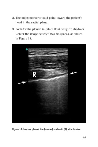 2. The index marker should point toward the patient s
   head in the sagital plane.

3. Look for the pleural interface ﬂanked by rib shadows.
   Center the image between two rib spaces, as shown
   in Figure 18.




Figure 18. Normal pleural line (arrows) and a rib (R) with shadow


                                                                    64
 