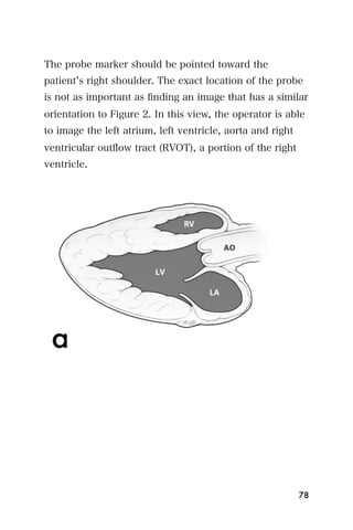 The probe marker should be pointed toward the
patient s right shoulder. The exact location of the probe
is not as important as ﬁnding an image that has a similar
orientation to Figure 2. In this view, the operator is able
to image the left atrium, left ventricle, aorta and right
ventricular outﬂow tract (RVOT), a portion of the right
ventricle.




                                                            78
 