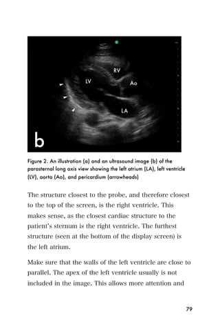 Figure 2. An illustration (a) and an ultrasound image (b) of the
parasternal long axis view showing the left atrium (LA), left ventricle
(LV), aorta (Ao), and pericardium (arrowheads)


The structure closest to the probe, and therefore closest
to the top of the screen, is the right ventricle. This
makes sense, as the closest cardiac structure to the
patient s sternum is the right ventricle. The furthest
structure (seen at the bottom of the display screen) is
the left atrium.

Make sure that the walls of the left ventricle are close to
parallel. The apex of the left ventricle usually is not
included in the image. This allows more attention and



                                                                          79
 