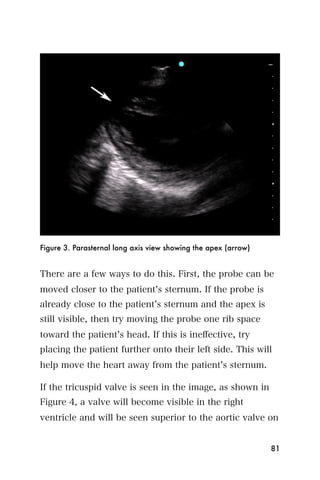 Figure 3. Parasternal long axis view showing the apex (arrow)


There are a few ways to do this. First, the probe can be
moved closer to the patient s sternum. If the probe is
already close to the patient s sternum and the apex is
still visible, then try moving the probe one rib space
toward the patient s head. If this is ineﬀective, try
placing the patient further onto their left side. This will
help move the heart away from the patient s sternum.

If the tricuspid valve is seen in the image, as shown in
Figure 4, a valve will become visible in the right
ventricle and will be seen superior to the aortic valve on


                                                                81
 