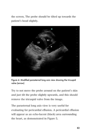 the screen. The probe should be tilted up towards the
patient s head slightly.




Figure 4. Modiﬁed parasternal long axis view showing the tricuspid
valve (arrow)


Try to not move the probe around on the patient s skin
and just tilt the probe slightly upwards, and this should
remove the tricuspid valve from the image.

The parasternal long axis view is very useful for
evaluating for pericardial eﬀusion. A pericardial eﬀusion
will appear as an echo-lucent (black) area surrounding
the heart, as demonstrated in Figure 5.


                                                                     82
 