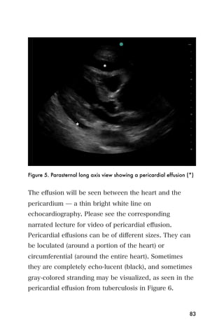 Figure 5. Parasternal long axis view showing a pericardial effusion (*)


The eﬀusion will be seen between the heart and the
pericardium ̶ a thin bright white line on
echocardiography. Please see the corresponding
narrated lecture for video of pericardial eﬀusion.
Pericardial eﬀusions can be of diﬀerent sizes. They can
be loculated (around a portion of the heart) or
circumferential (around the entire heart). Sometimes
they are completely echo-lucent (black), and sometimes
gray-colored stranding may be visualized, as seen in the
pericardial eﬀusion from tuberculosis in Figure 6.



                                                                     83
 